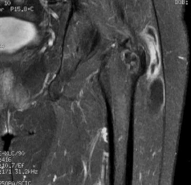Figure 2 for case TB abscess hip